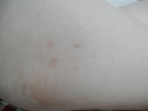 银屑病的预防
