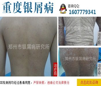 银屑病秋冬复发因素有哪些