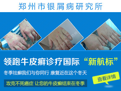 郑州银屑病