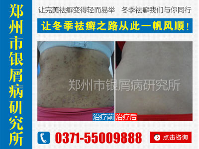 牛皮癣能治好吗