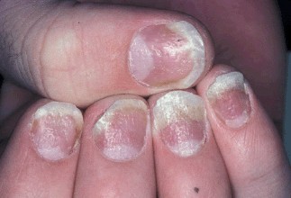 手部牛皮癣如何康复