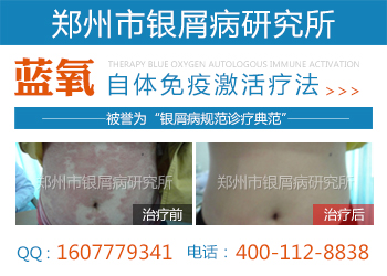 郑州市银屑病研究所好吗
