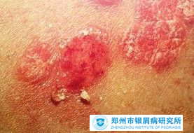 牛皮癣的护理方法有哪些