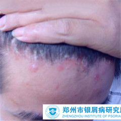 头部牛皮癣该如何治疗