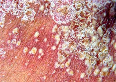 秋季牛皮癣患者要谨防感冒