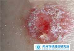 寻常型牛皮癣有什么发病症状