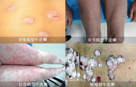 引起脓疱型牛皮癣病因有哪些