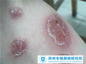 牛皮癣会引起哪些并发病