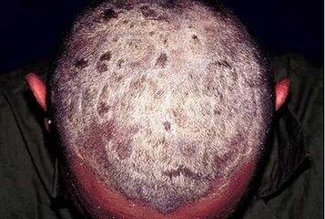 牛皮癣患者日常保健措施