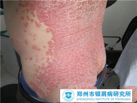 红皮病型牛皮癣要注意哪些