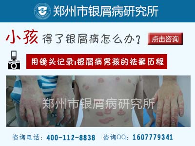 牛皮癣是哪些因素导致的