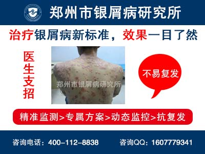 牛皮癣患者洗澡要注意哪些
