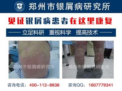 头部牛皮癣为什么会加重呢