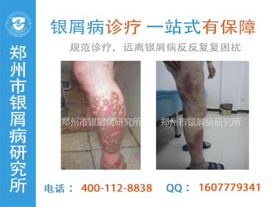 成人牛皮癣该怎么护理呢