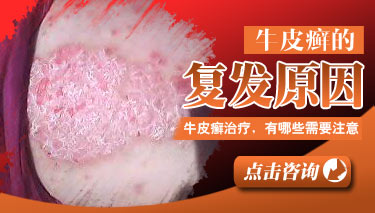 防止牛皮癣复发的方法有哪些?