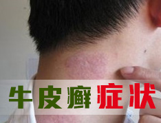 红皮病型银屑病有什么症状呢