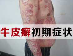 银屑病的表现是什么