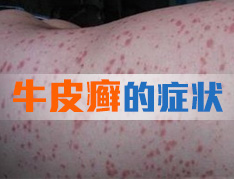 牛皮癣有哪几种类型?
