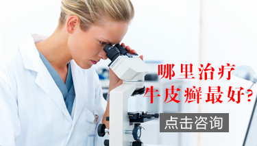 红皮型银屑病如何治疗?