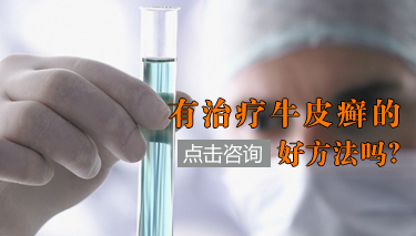 早期牛皮癣可以治好吗?