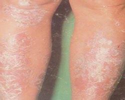 牛皮癣的病因都有哪些