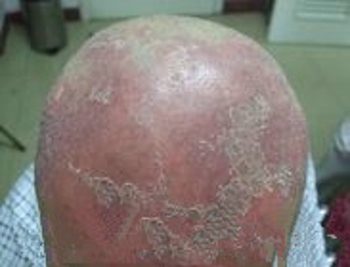 头部牛皮癣用什么洗头好