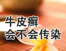 得了牛皮癣会传染吗