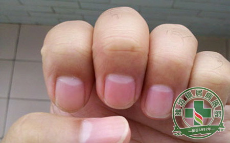 郑州市银屑病研究所