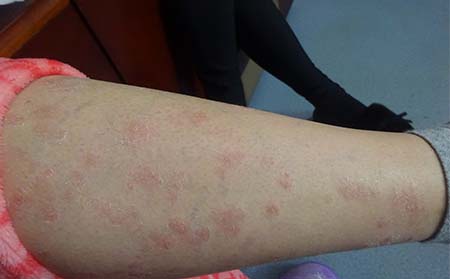 腿部有牛皮癣怎么治疗好