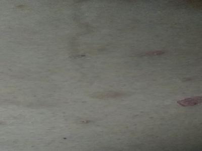 预防牛皮癣扩散的方法是什么
